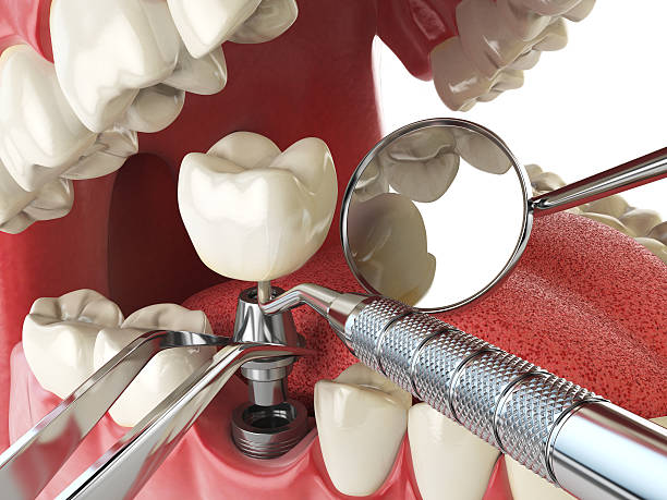 Best Emergency Root Canal Treatment in North Gates, NY